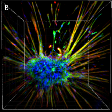 Lung cancer cells grown in a spongy 3D gel that mimics lung tissue